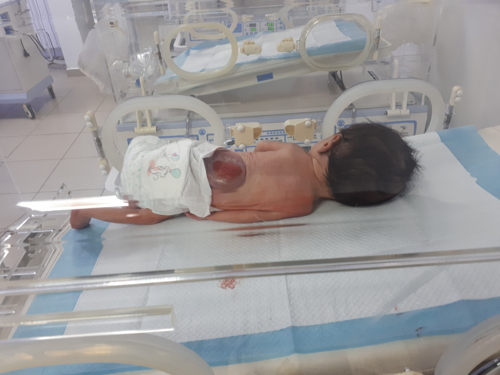 طفل خُلق بفتحة في ظهرهِ وماء في رأسه!