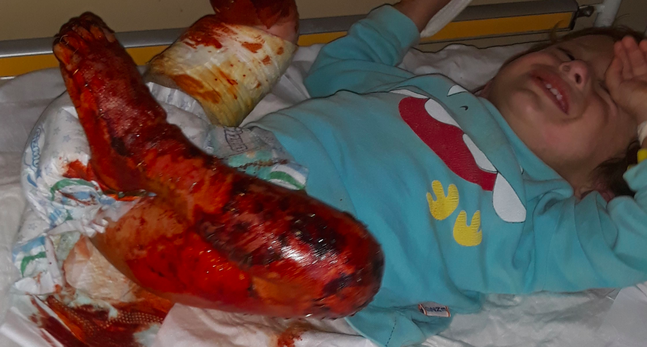 A child with severe burns