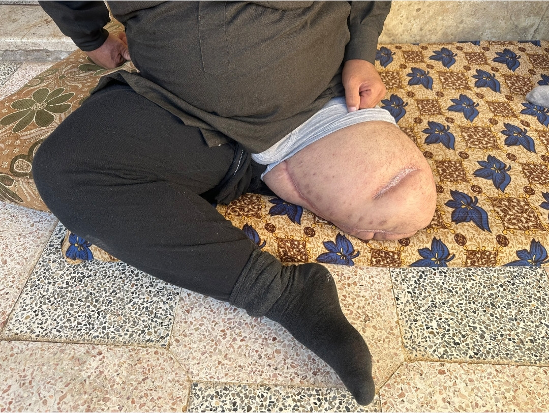 Due to a car accident, Uncle Imad underwent an amputation of his left leg.