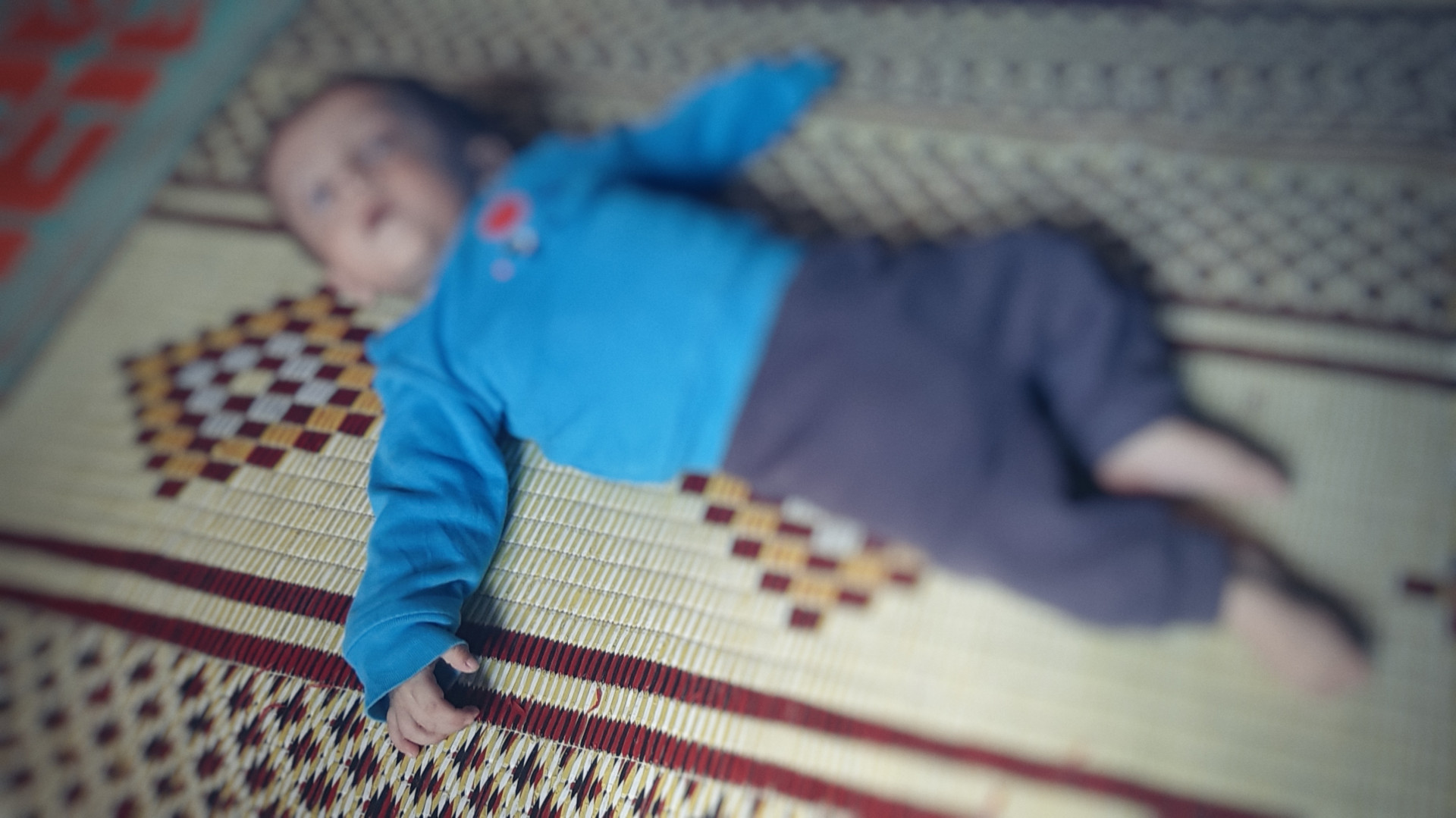 A child suffers from hydrocephalus