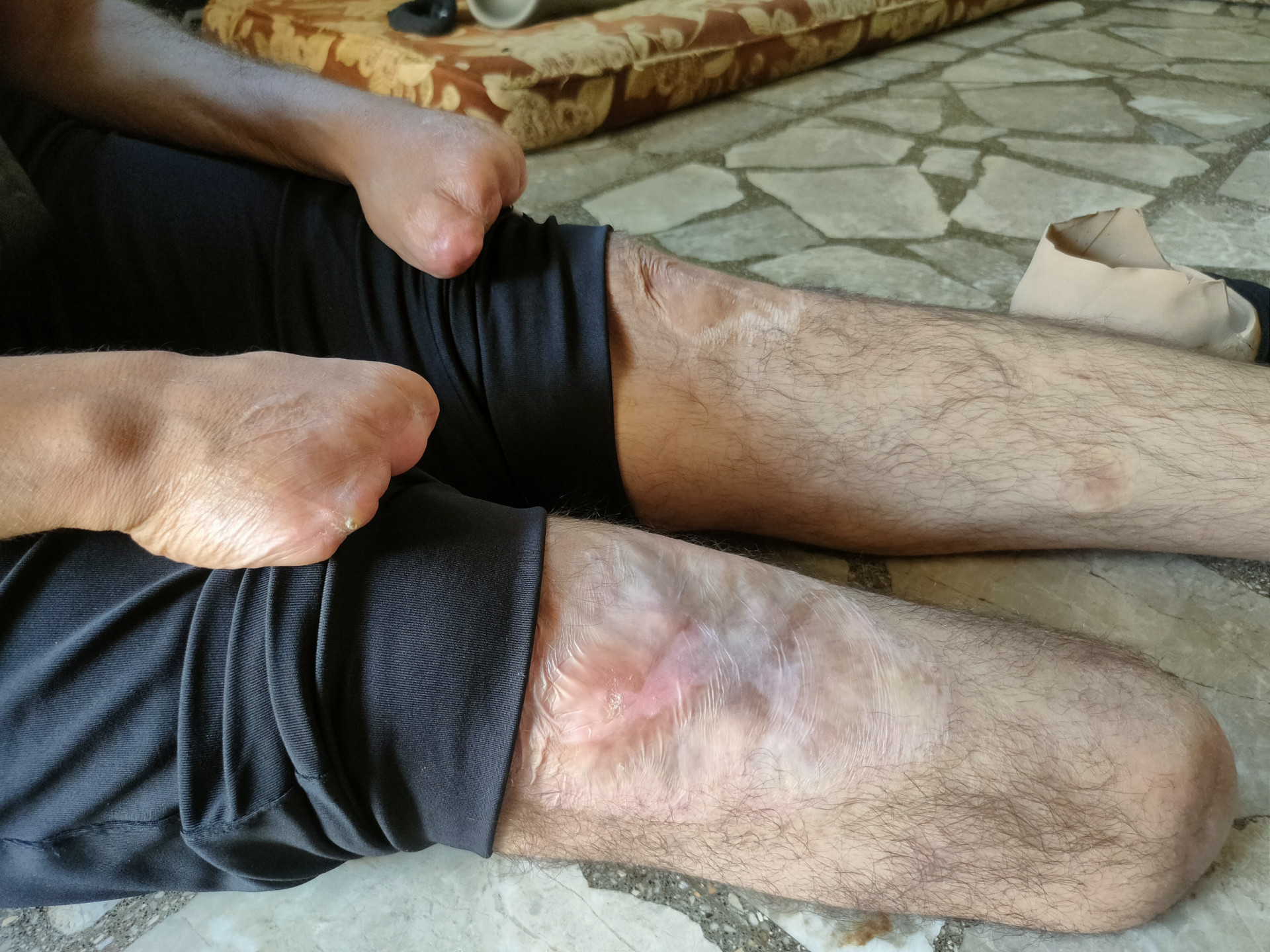 A father lost his limbs and gained suffering