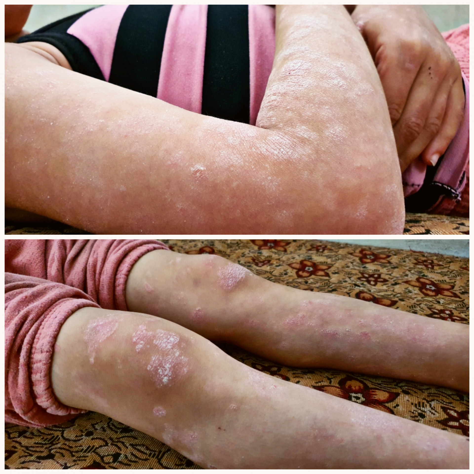 Limar suffers from psoriasis and needs urgent treatment