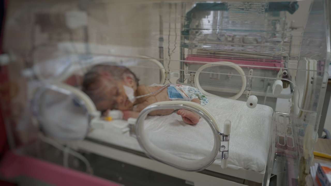 A newborn with hydrocephalus