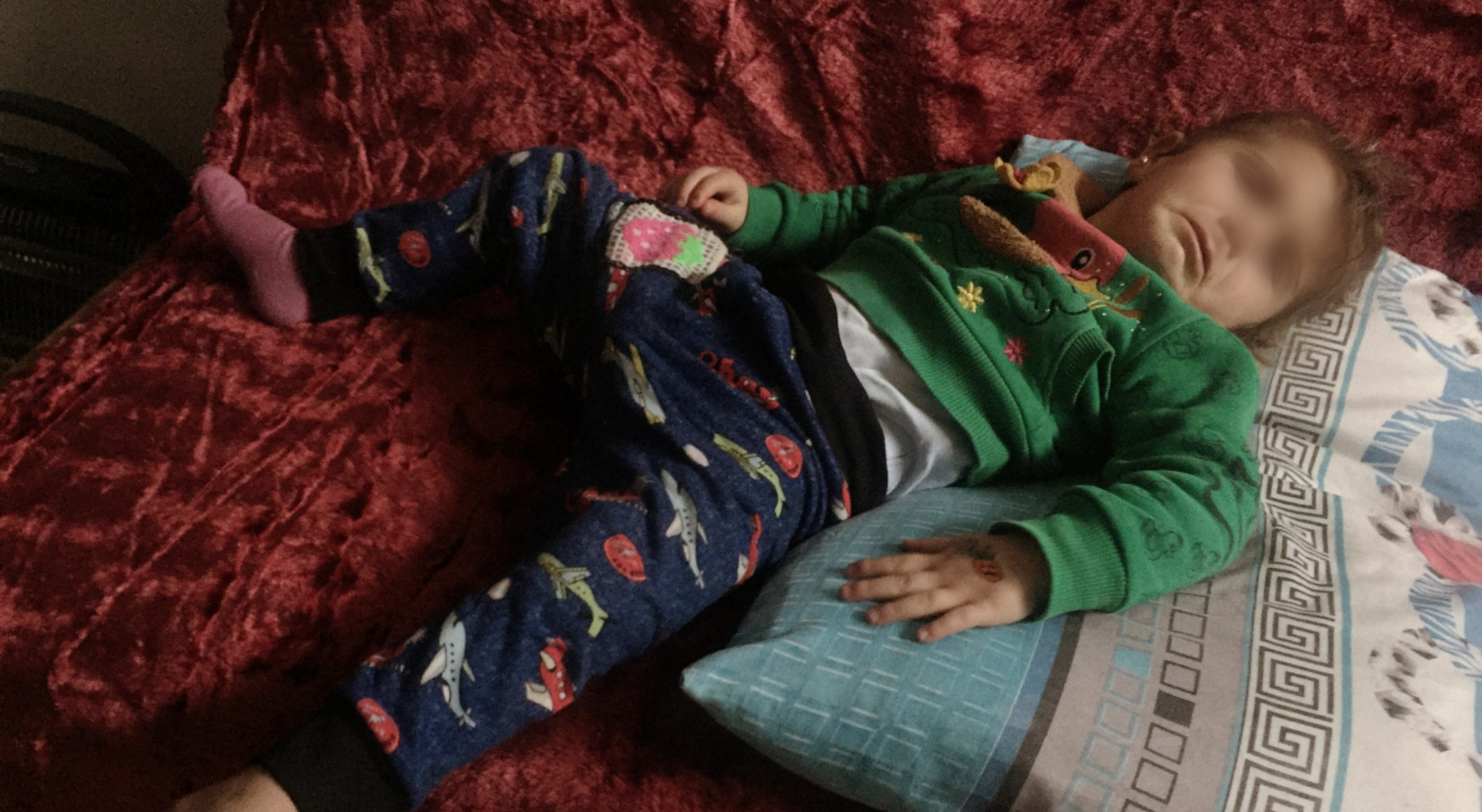 A girl child with hip dislocation