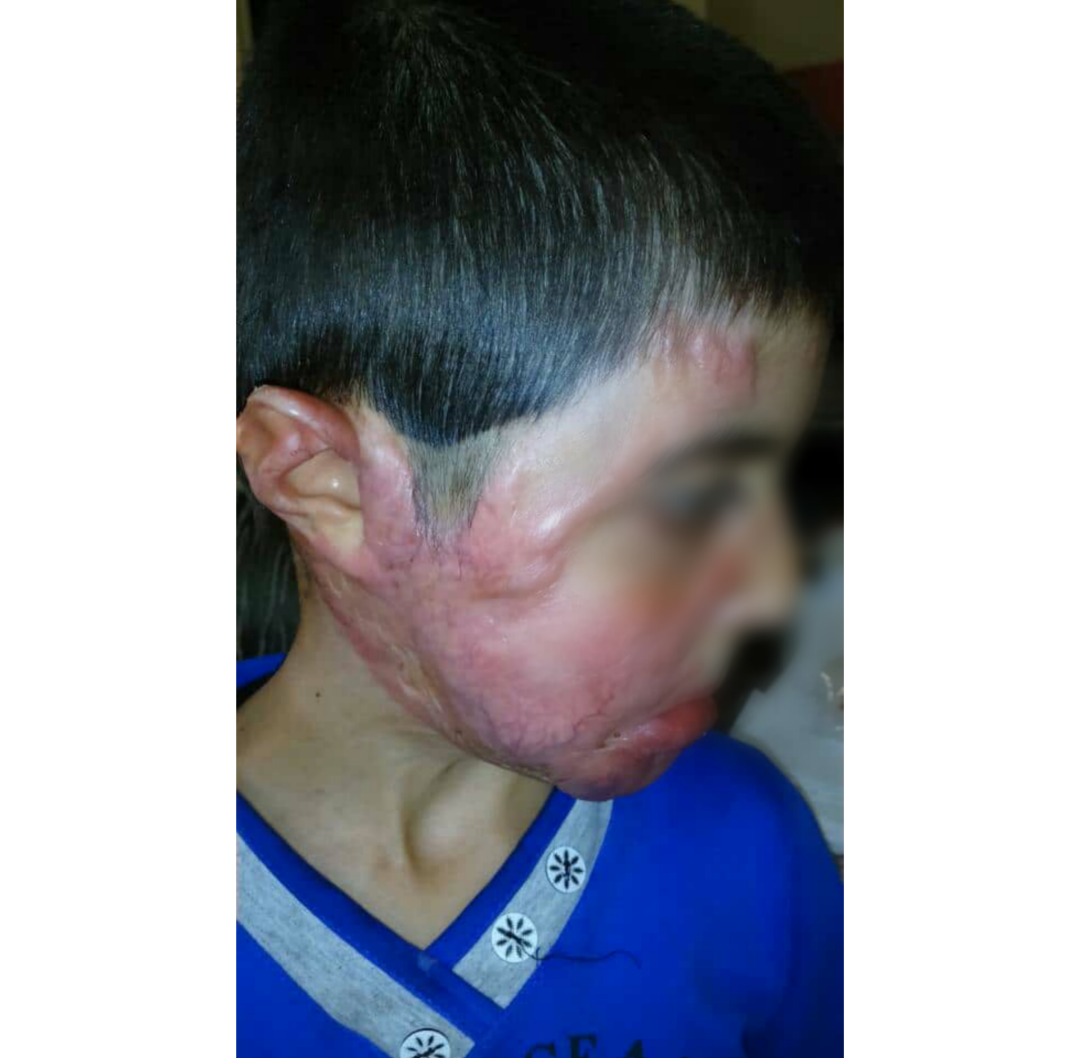 A child with severe burns with boiling oil