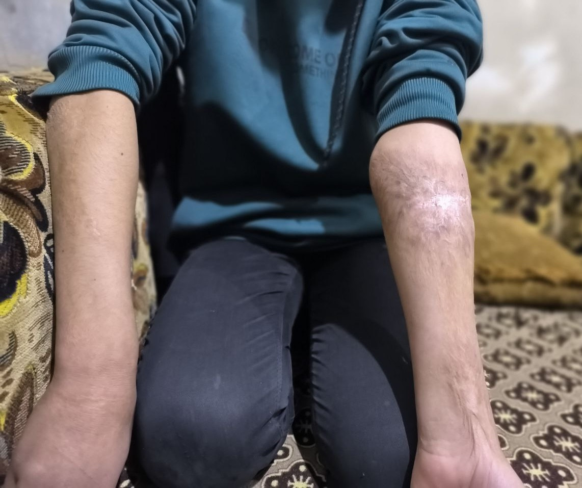 Severe Burns and Deep Pain Cover Rimas' Hands