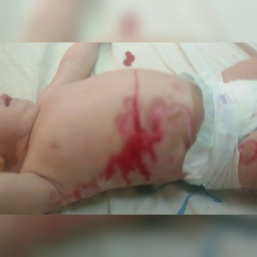 a child with sever burns