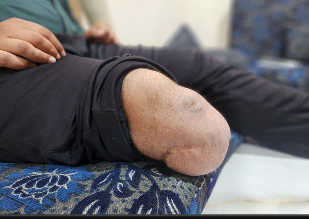 Zaid... the war took his mother and left him with a disability
