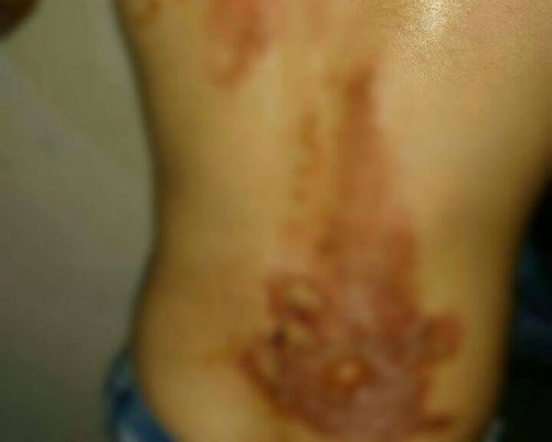 A refugee child in Lebanon needs burns treatment
