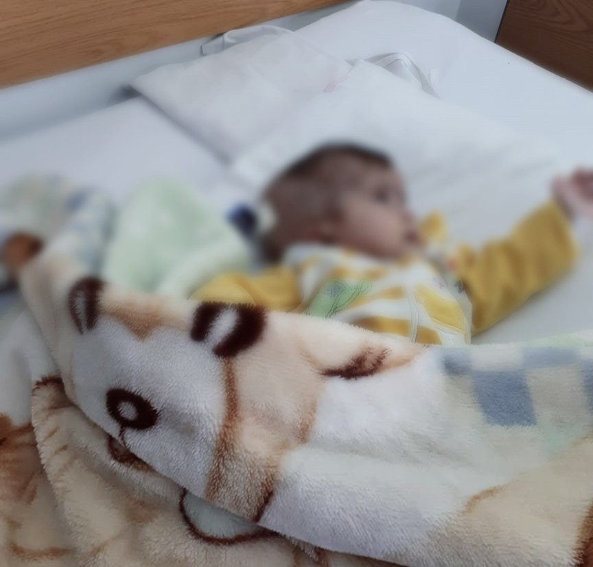 baby with hydrocephalus