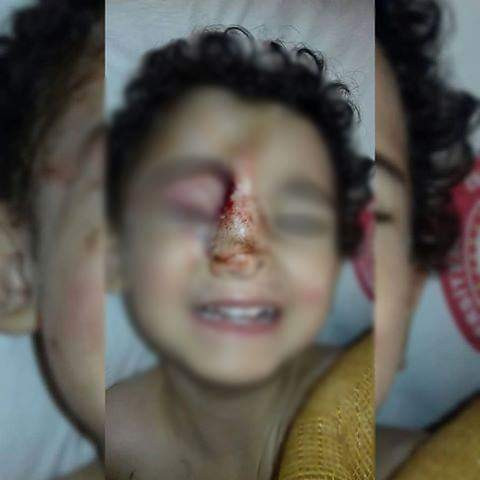 Kid with 4 fragments in the face and lost his eye