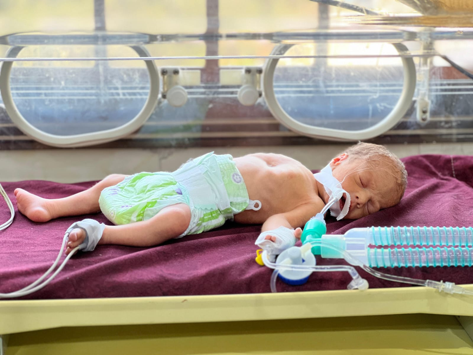 Premature Twins are on Ventilators