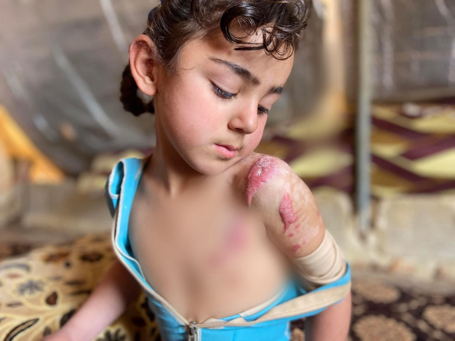 طفلة حرقت بالزيت وبحاجة لأدوية!