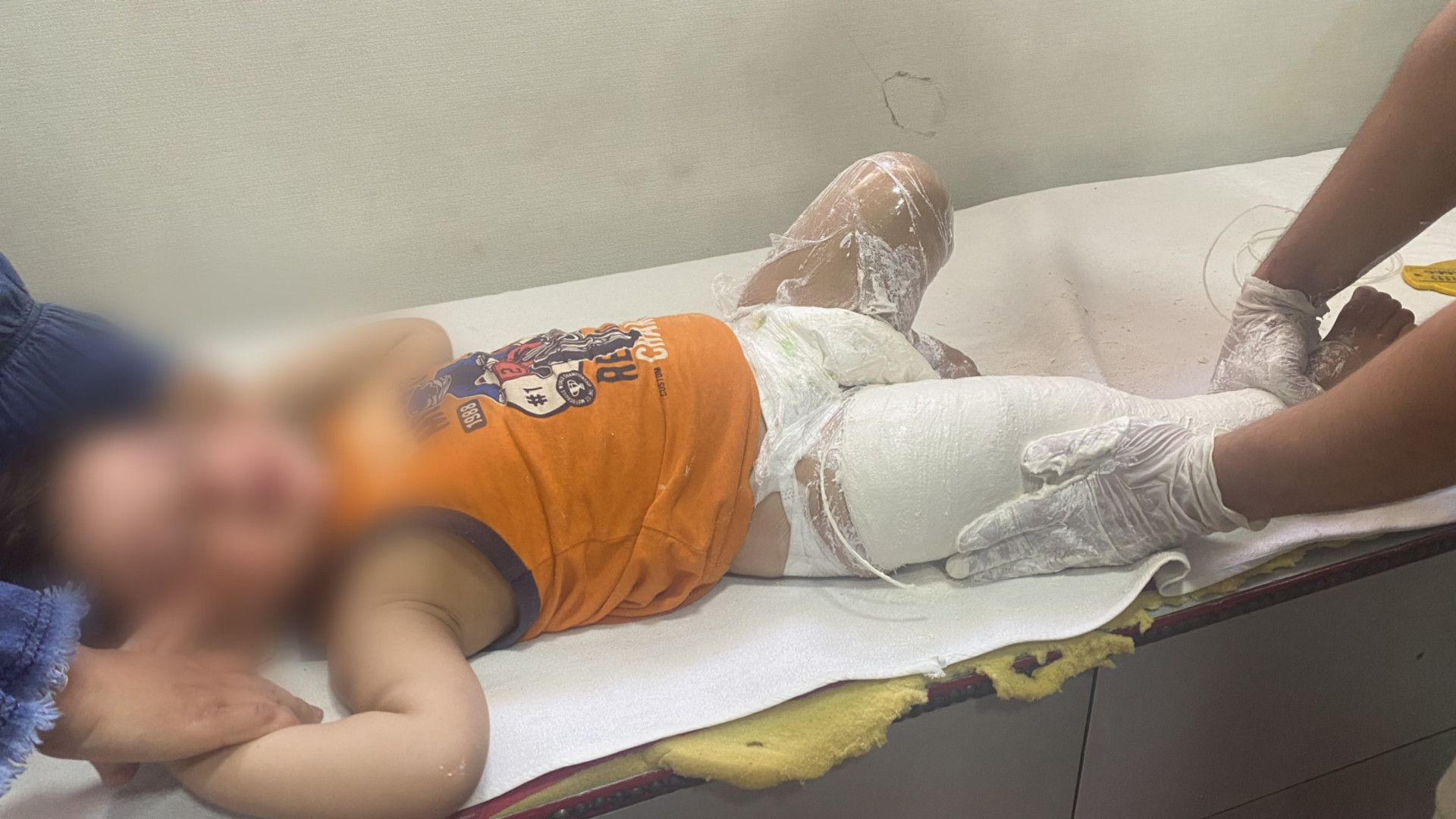 Mustafa suffers from bowleg deformity and needs medical device of leg corrections