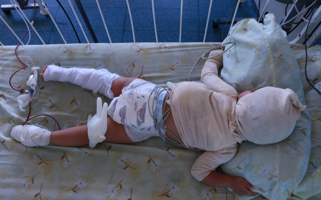 Two children with severe burns