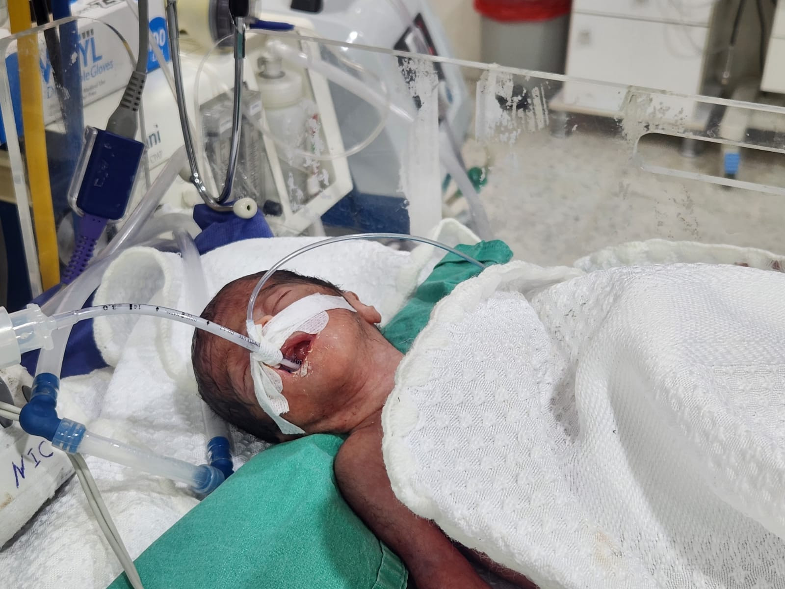 A baby suffers from respiratory distress syndrome