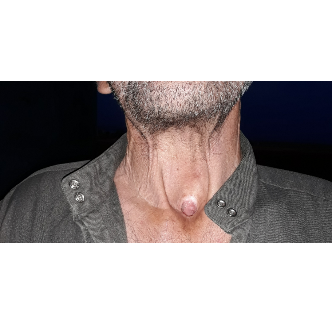 رجل ترك له السرطان فتحة في حلقه!