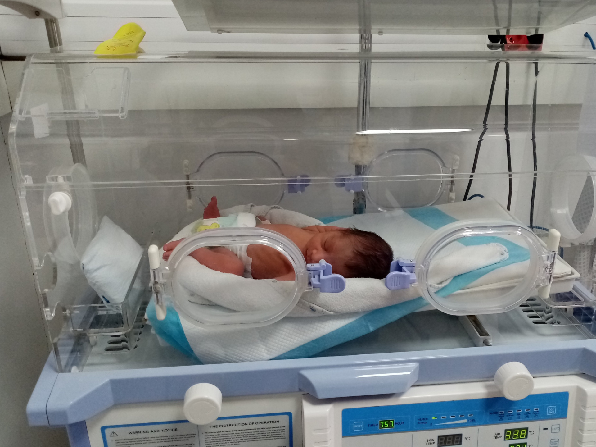 He was born with underdeveloped lungs.