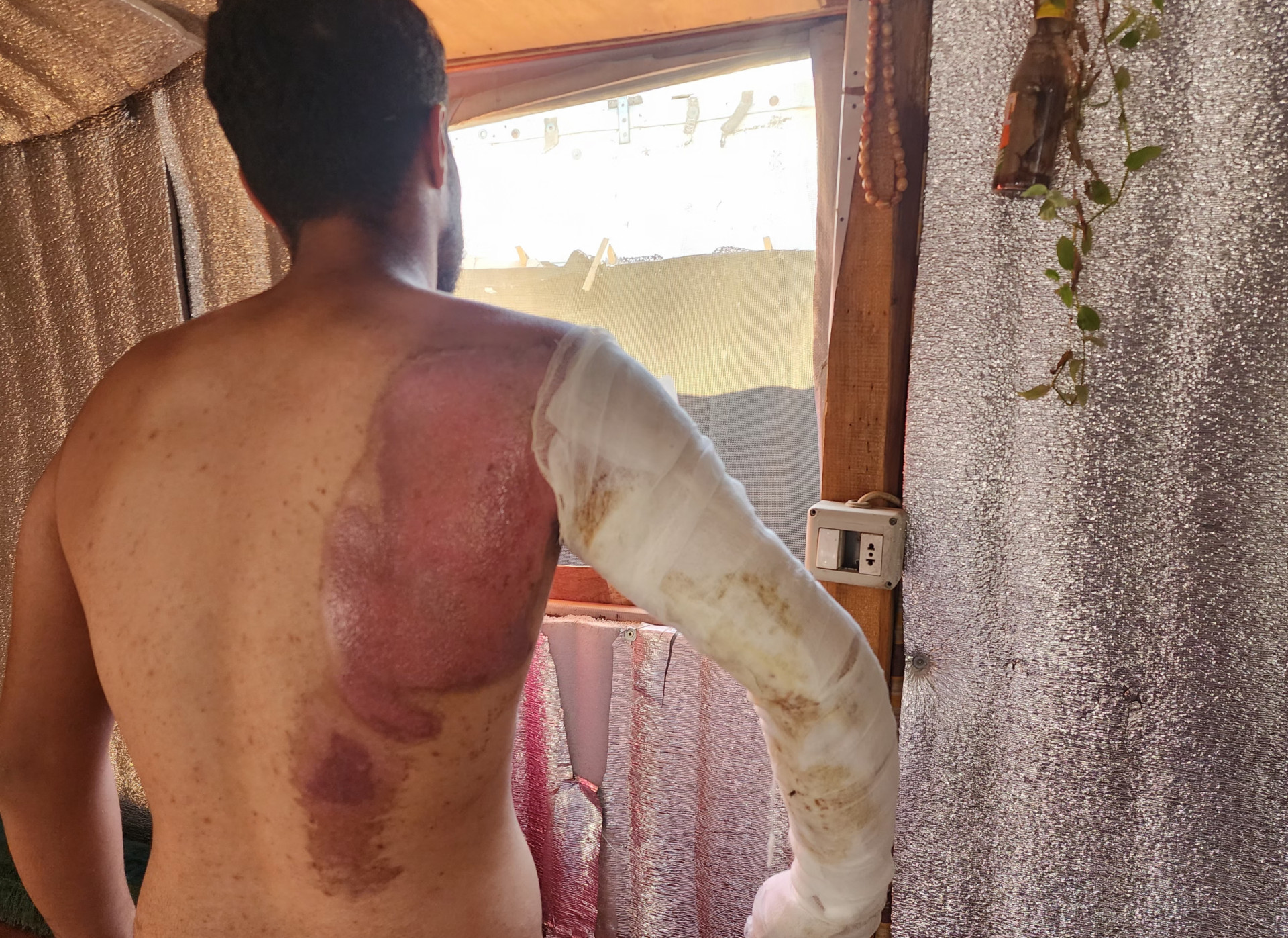 Qusai suffered third-degree burns while working! He needs urgent treatment!