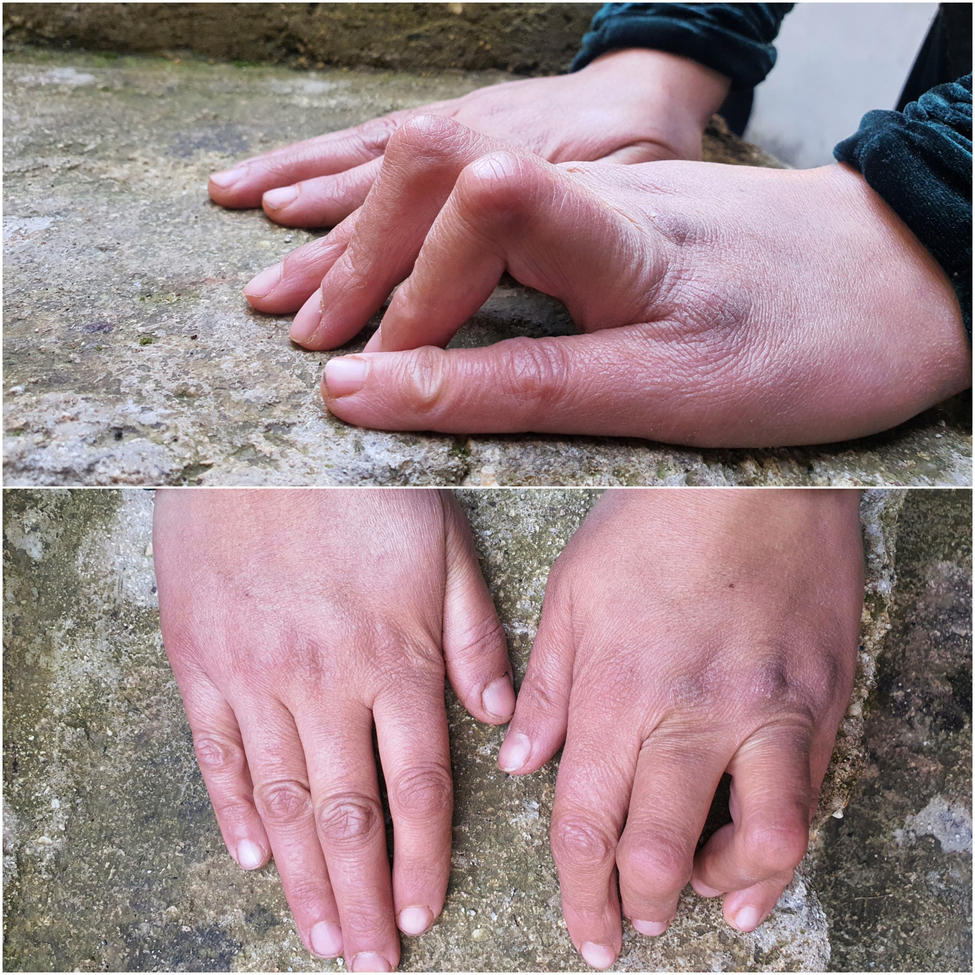 Asma'a is with rheumatoid arthritis, exposes her life to risk