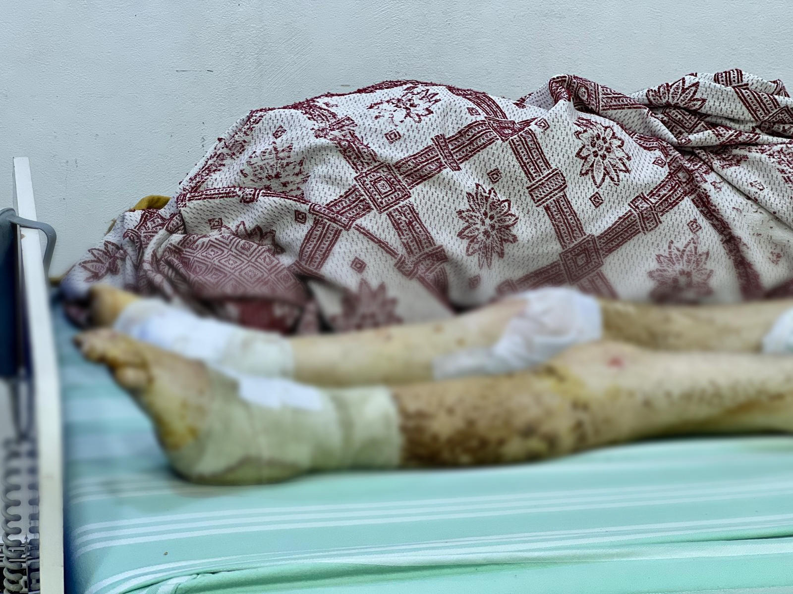 عملية جراحية دمرت حياة حمزة