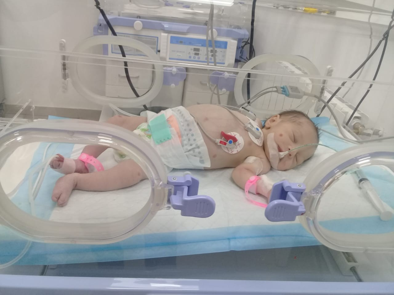 طفلة تحتاج لعملية مستعجلة