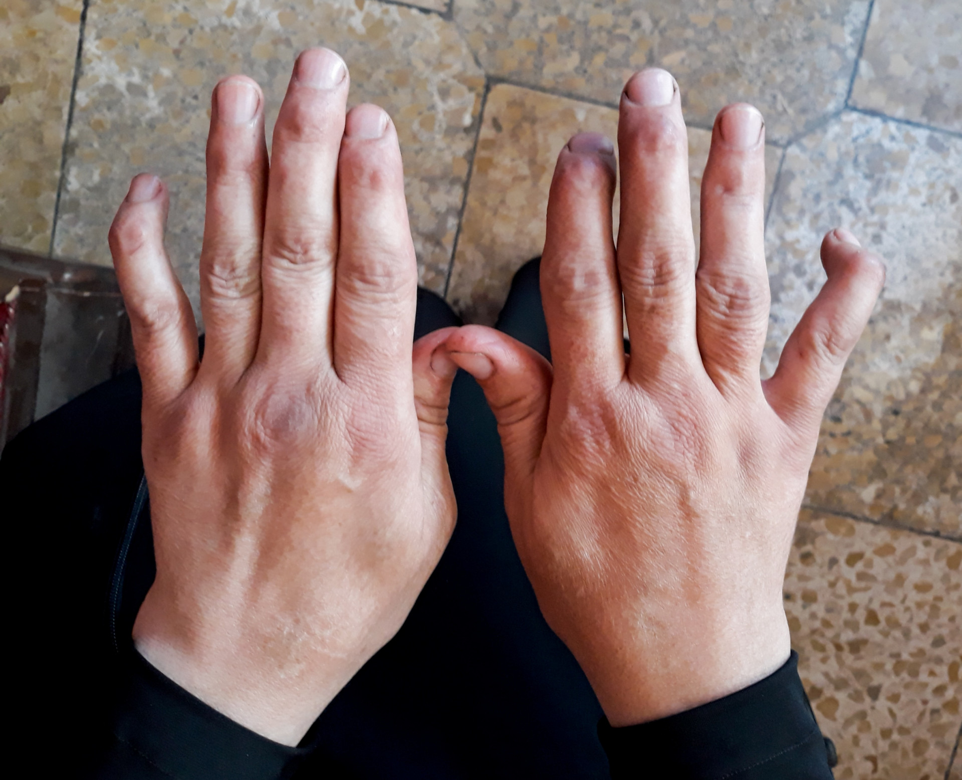 Rowida has rheumatoid arthritis