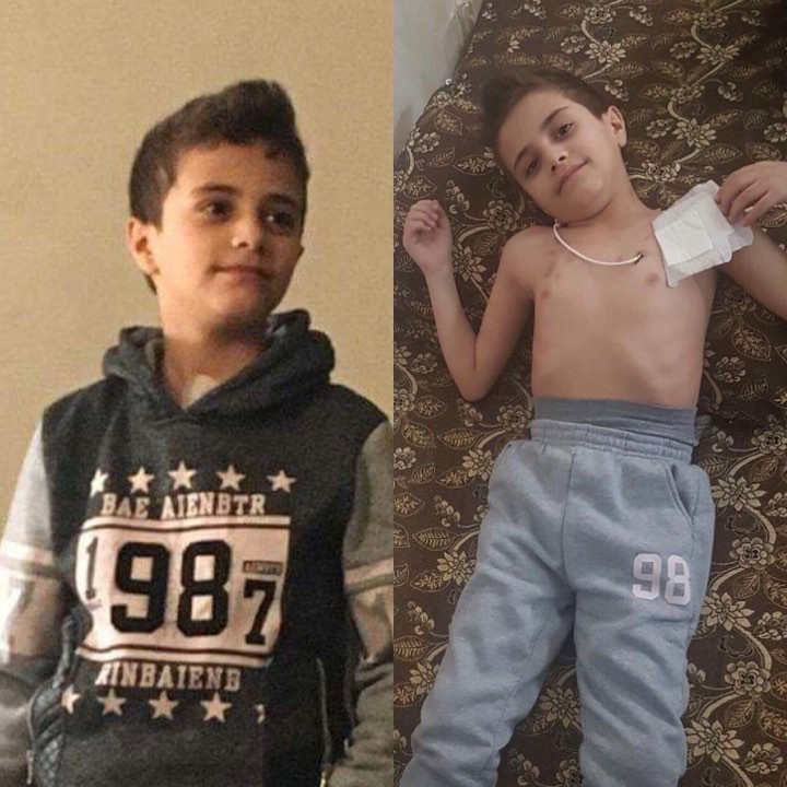 a kid with liver cirrhosis