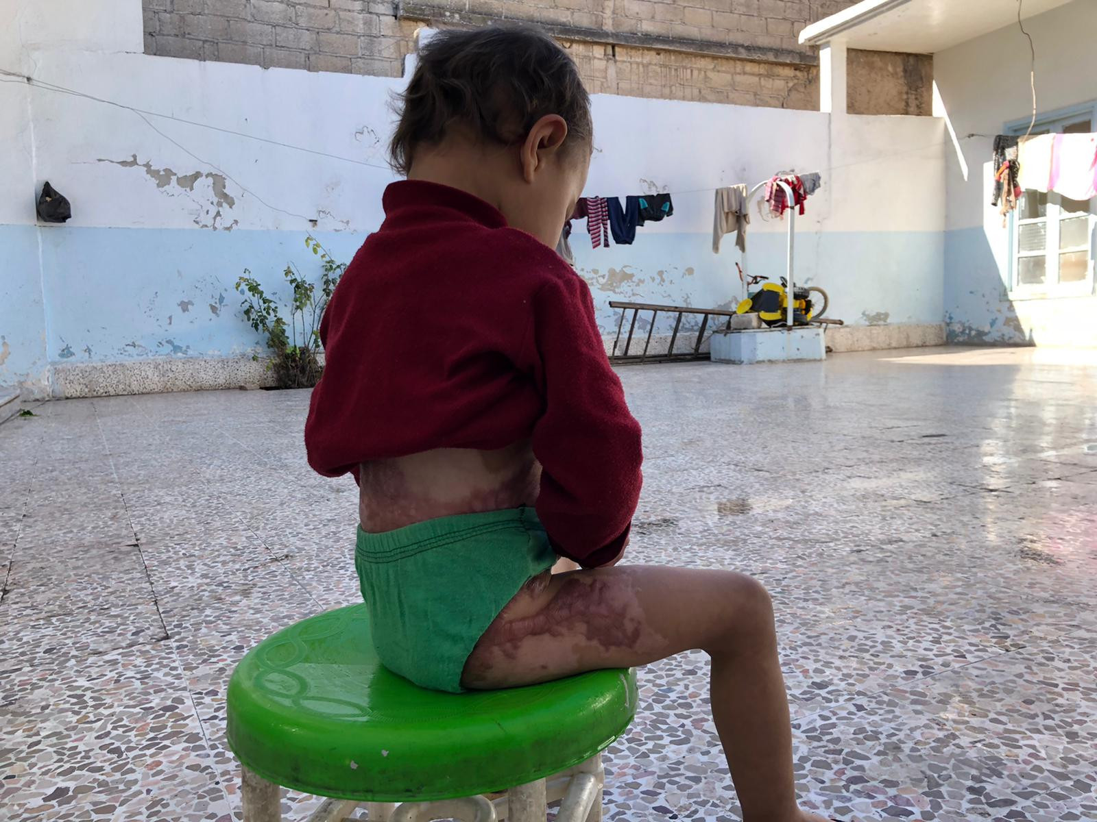 A child with severe burns