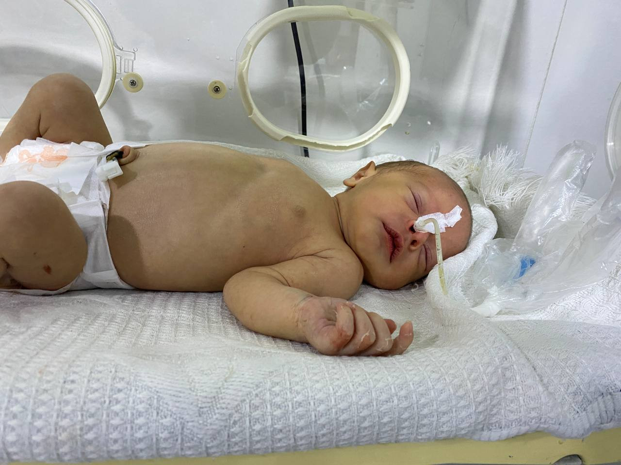 Lamees was born with intestinal atresia and needs urgent surgery