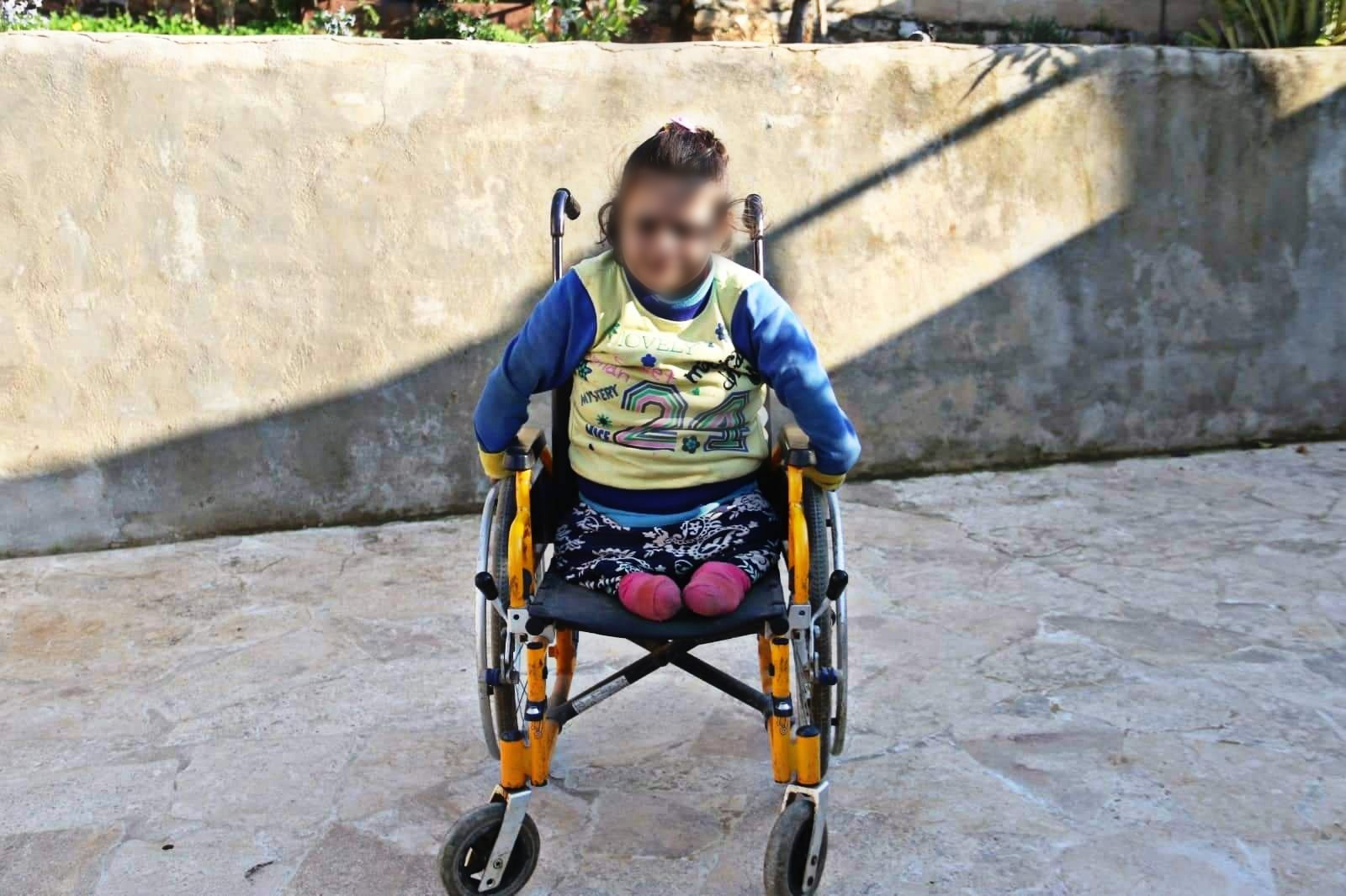 طفلة ولدت بِلا قدمين ويدين!