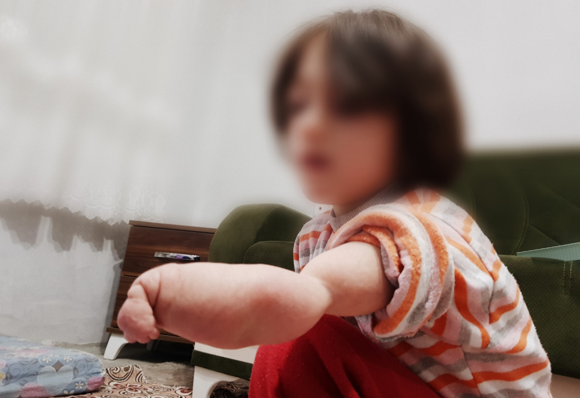 طفلة خُلقت بيد مشوهة وغير مكتملة النمو