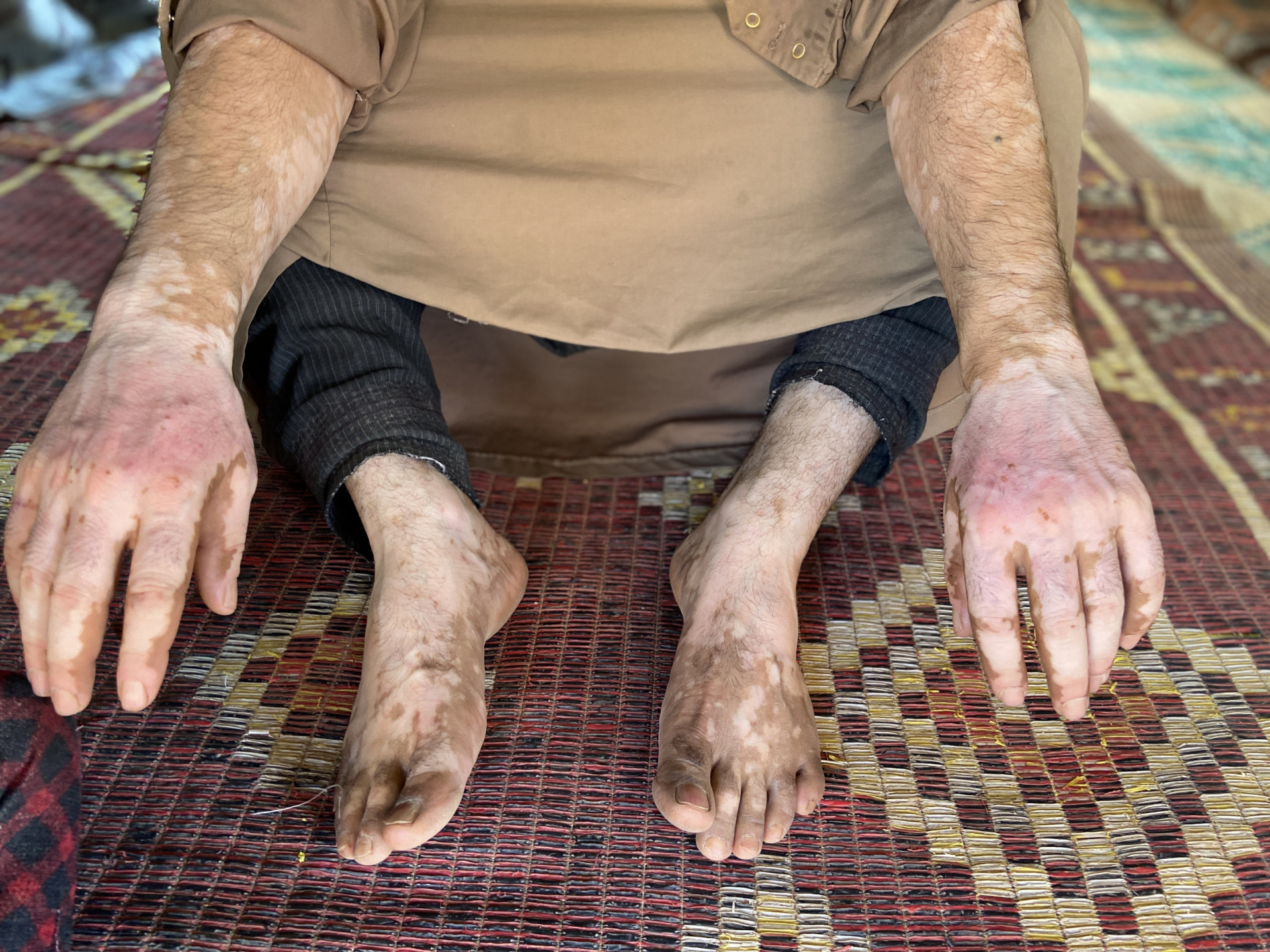 A dilapidated tent shelters malnourished children