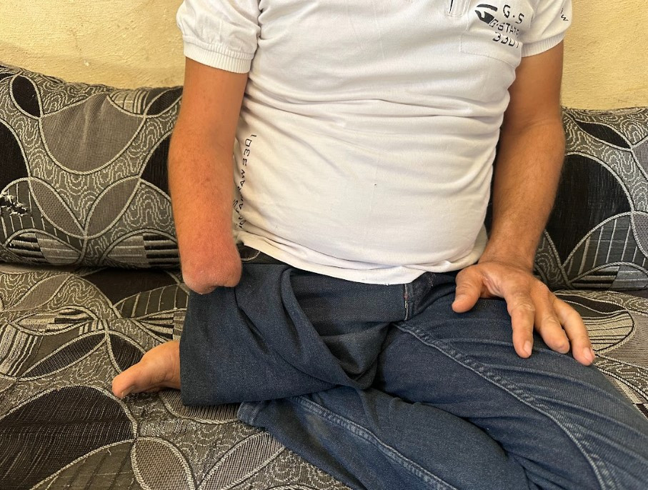 Muhammad, a displaced person from the Damascus countryside, was injured and lost his right limb
