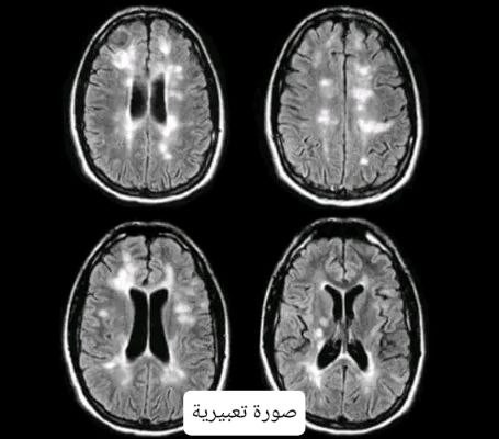 Aisha’s Urgent Need for Brain Surgery