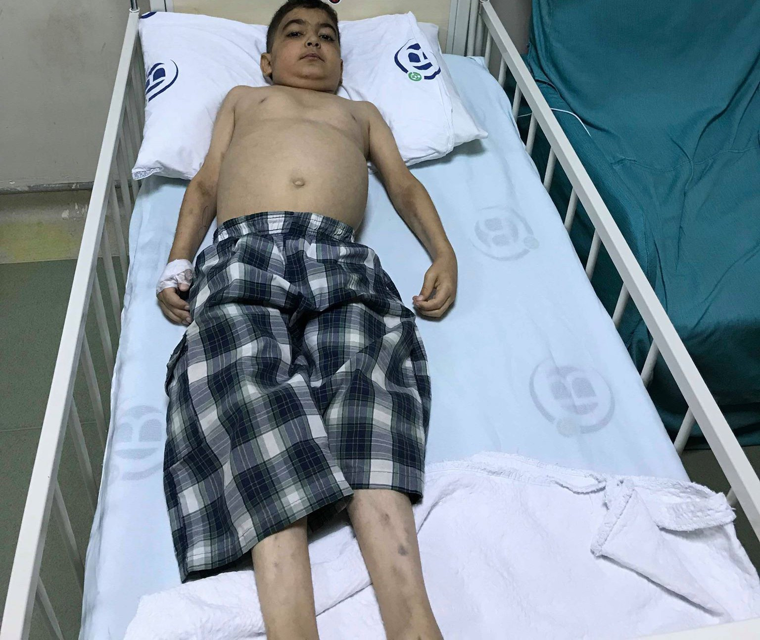kid with very weak immune system, breathing difficulties and kidneys shutdown