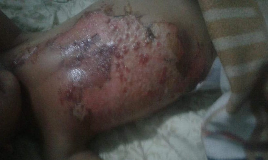 A Little Girl Has to Have an Urgent Care for a Burn