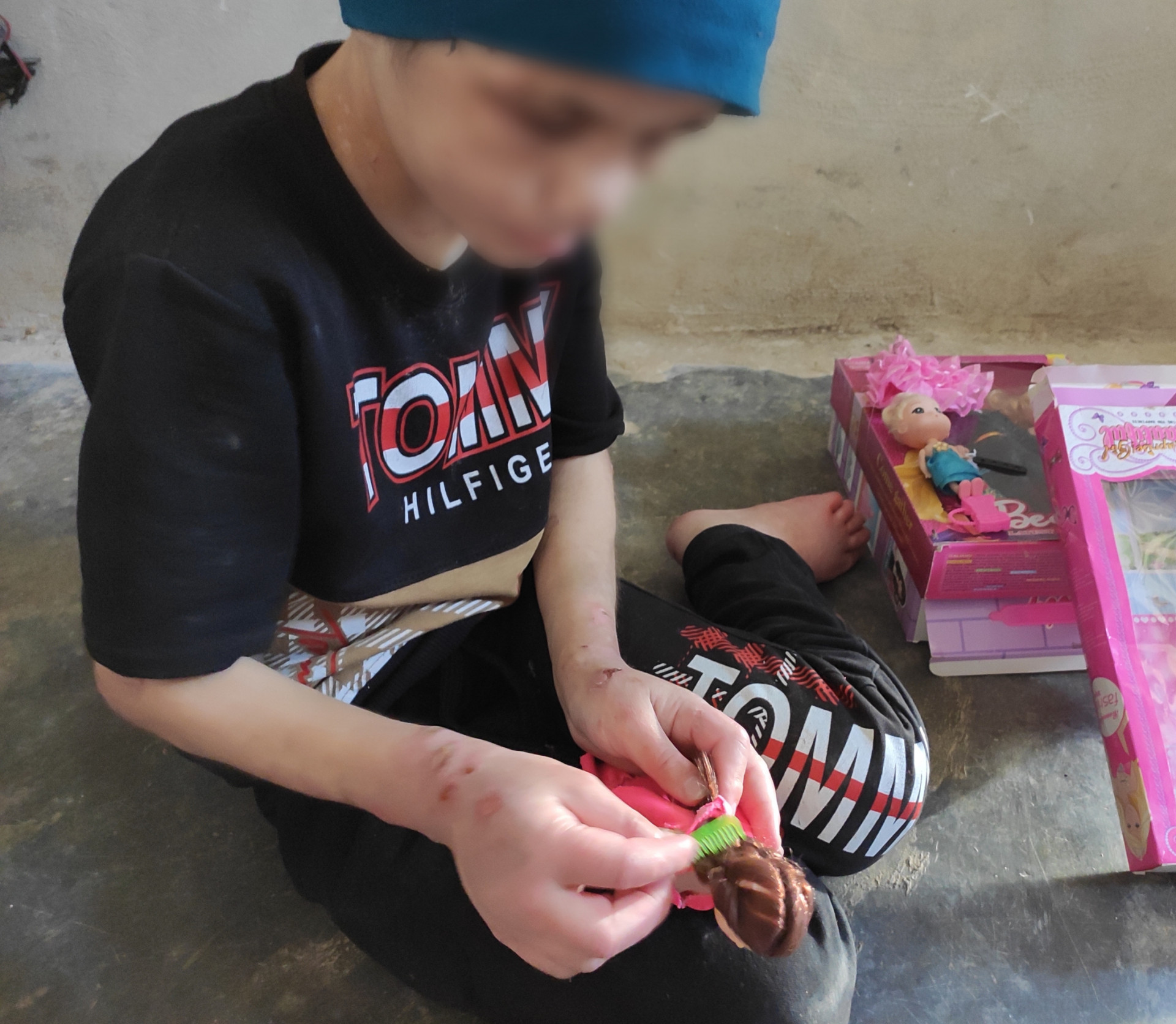 The child Ola has burns and needs medicine and ointments to relieve her pain.