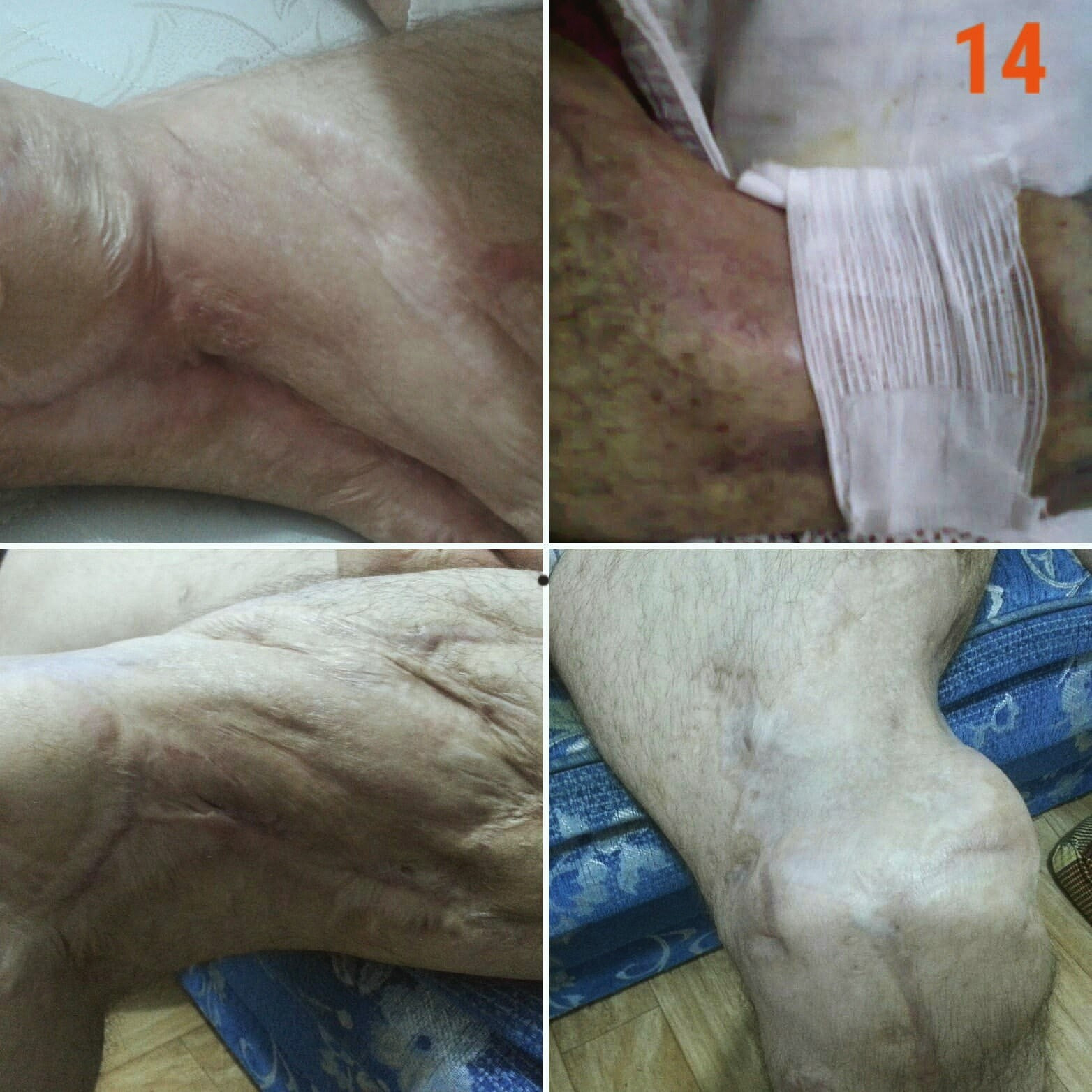 a man with multiple injuries after a shrapnel