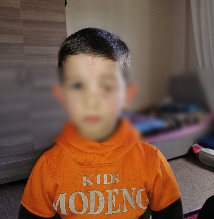 طفل سلب منه القصف عينه