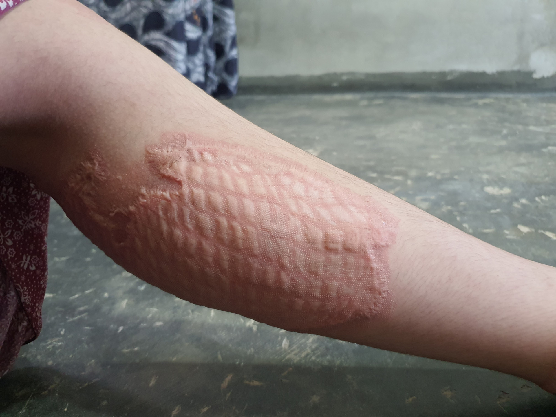 She fears for her future every time she sees the scars on her body. Let’s support Noor.