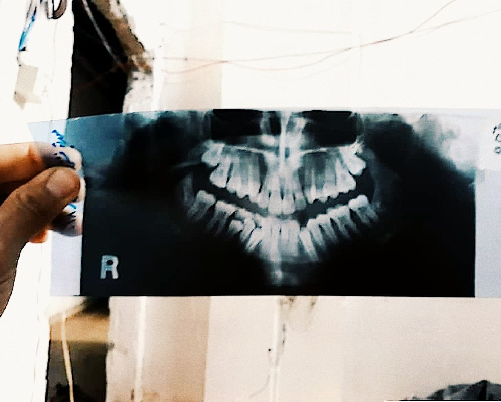 child with protuberance of teeth