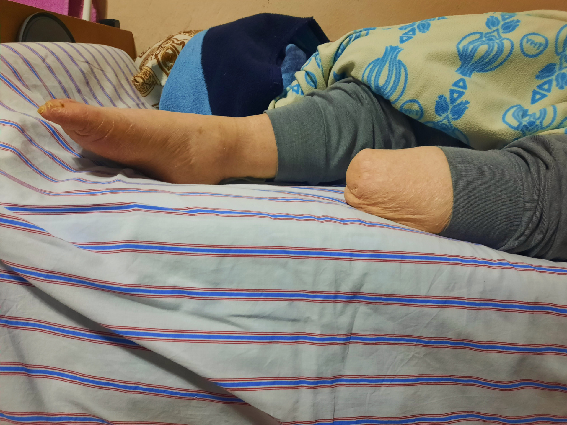At the age of seventy, he faces life with an amputated leg and a chronic disease!