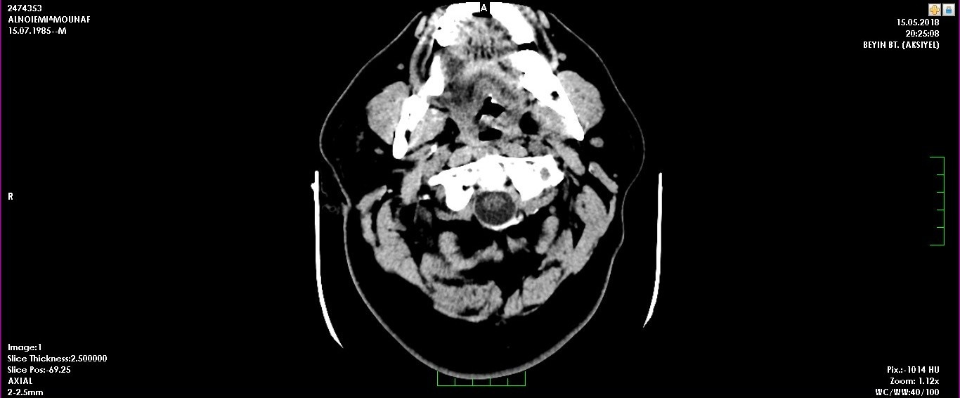 A young man with cerebral stroke