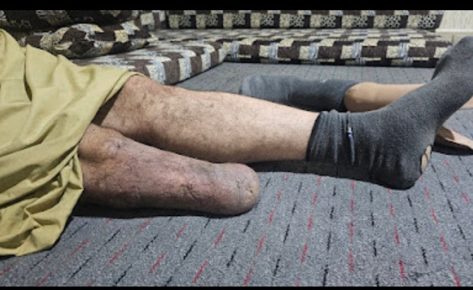 He Lost His Leg, Yet Still Provides for His Family