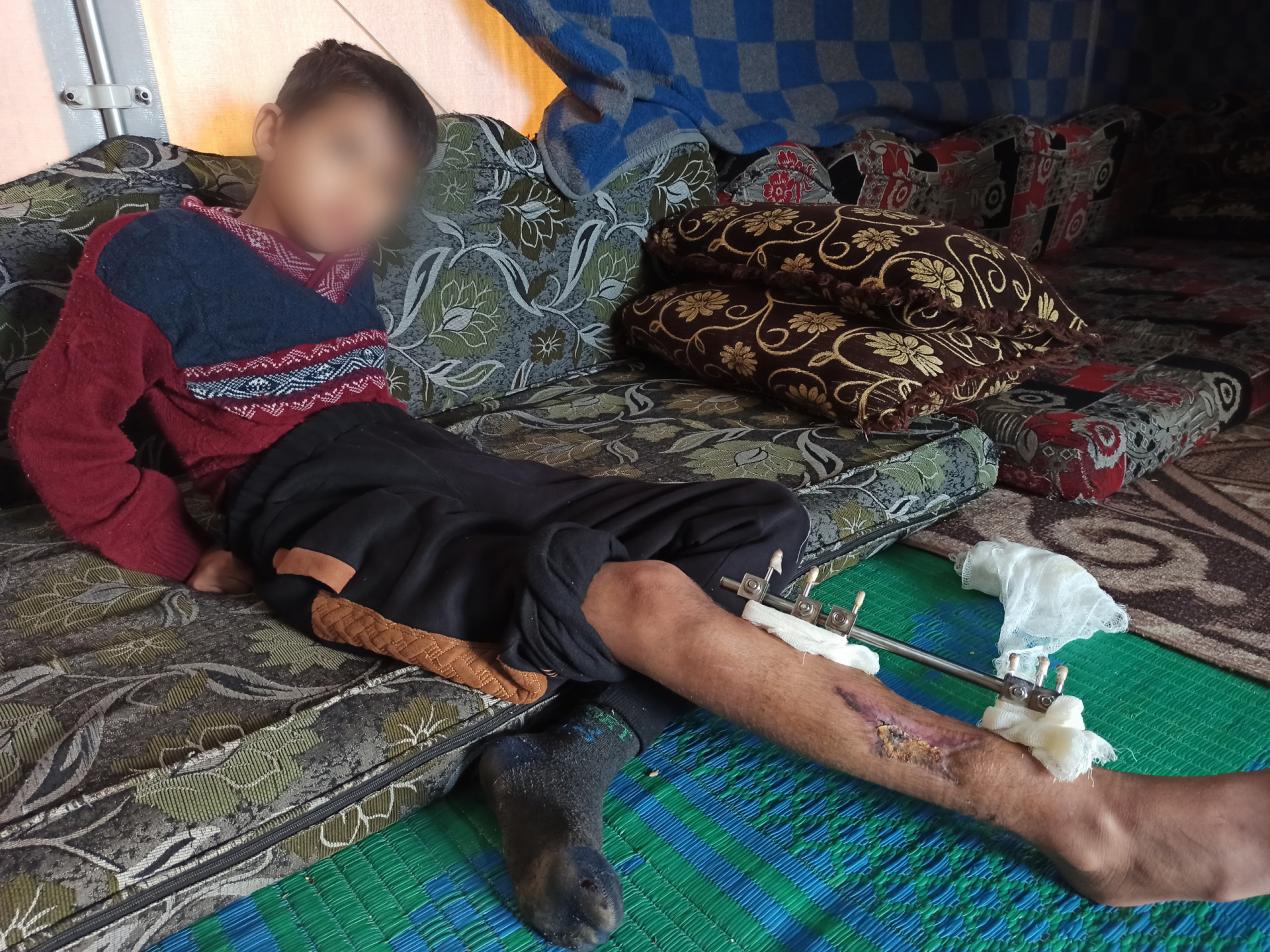 Your donation will save Hossam's leg