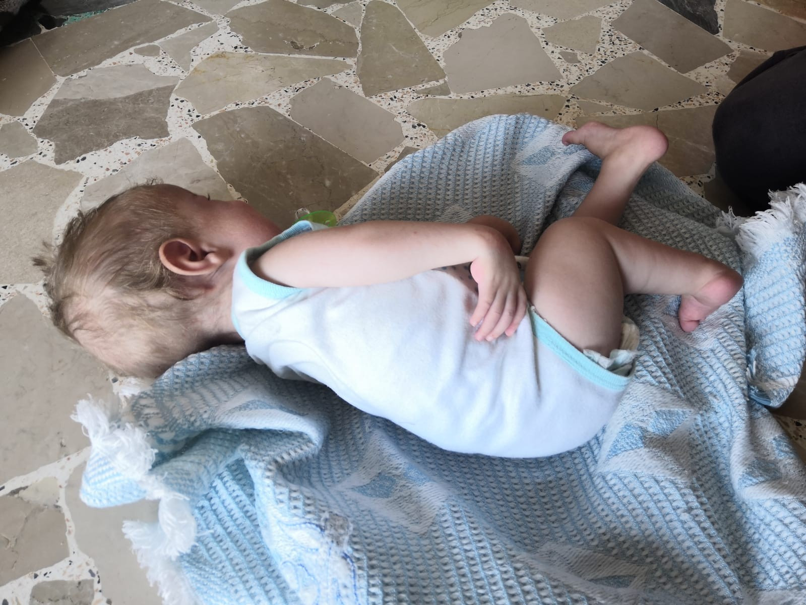 A child with out-toeing feet