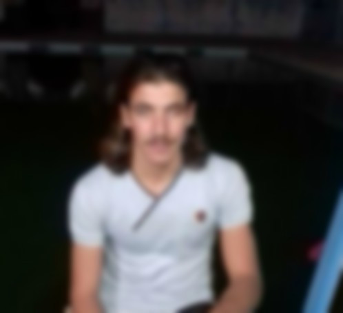 Young man needing a lens impant