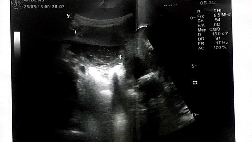 A woman suffers of bleeding needs an urgent surgery