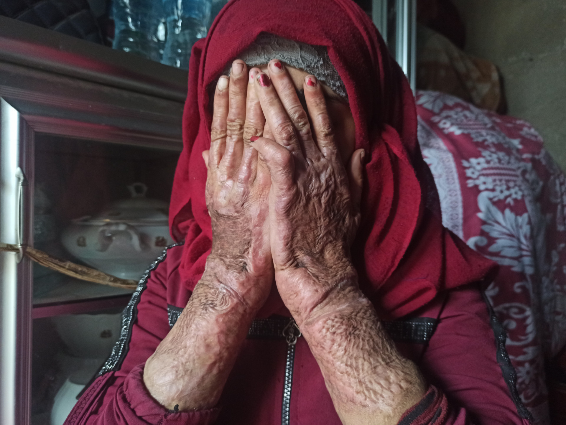 طفلة حرق جسدها وتعيش في خيمة!